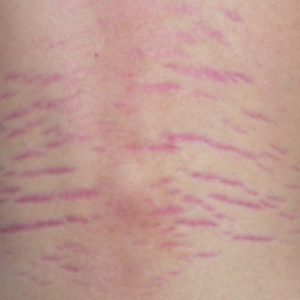 Stretch Marks — Treatments, Causes and Prevention