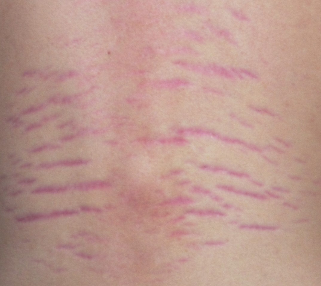 Stretch Marks Explained: Causes, Prevention, and Treatments